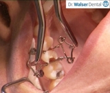 Walser Teilmatrizensystem/Foto: Dr. Walser Dental