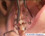 Walser Matrize/Foto: Dr. Walser Dental GmbH