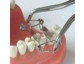 Dr. Walser Dental: In Asien meist gelesene Veröffentlichung über weltweit erfolgreiche Matrizen
