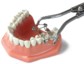 Walser Dental: Noch schneller mit der neuen Matrizen- und Kofferdamklammerzange