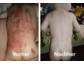 Theresienöl – Durch traditionelles Wundheilmittel können Hauttransplantationen bei Verbrennungen und Verbrühungen vermieden werden